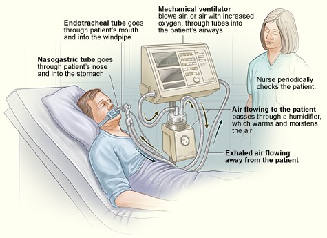 What is a Ventilator